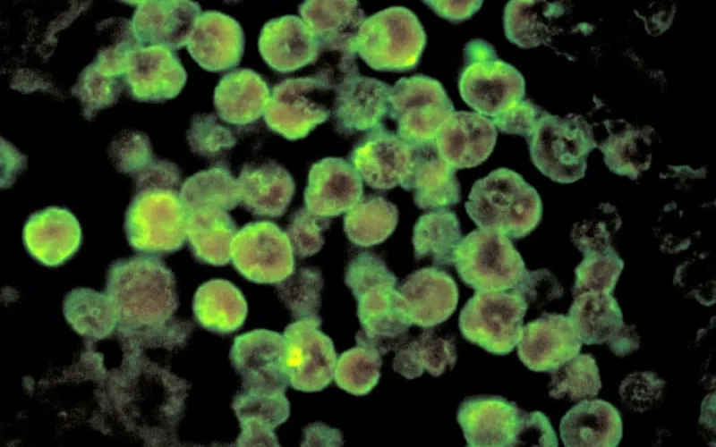 North Carolina teenager dies from rare infection caused by brain-eating amoeba