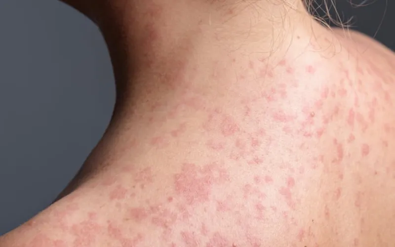 California warns of measles exposure in six counties from unvaccinated train passenger